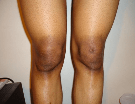 How to lighten dark knees